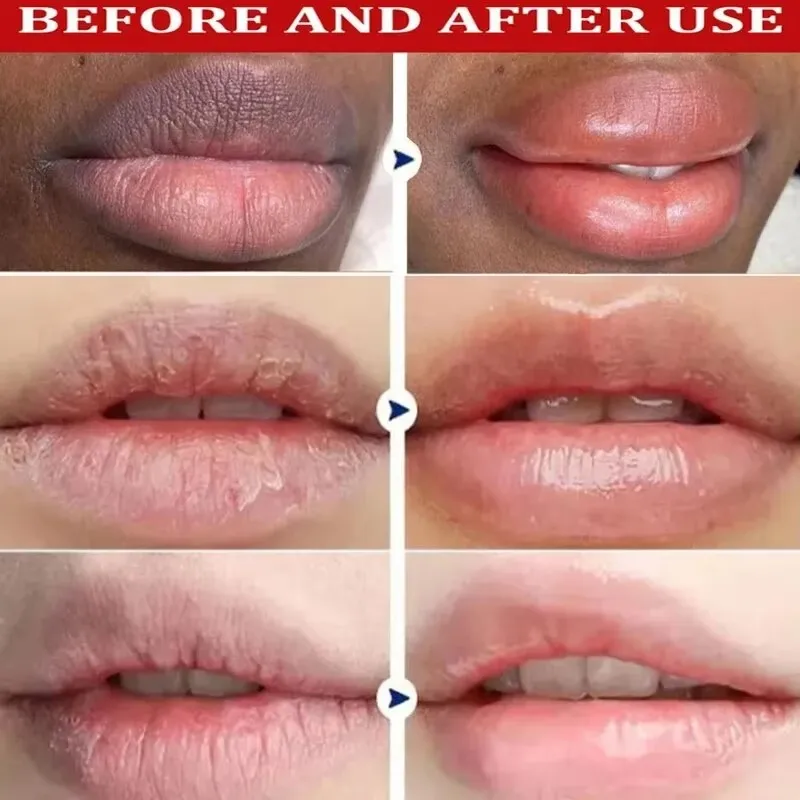 다크 립 밤 제거 라이트닝 멜라닌 마스크 글로스 엑스폴리에이팅 립 핑크 트리트먼트 립 라인 감소 건조함 개선 보습