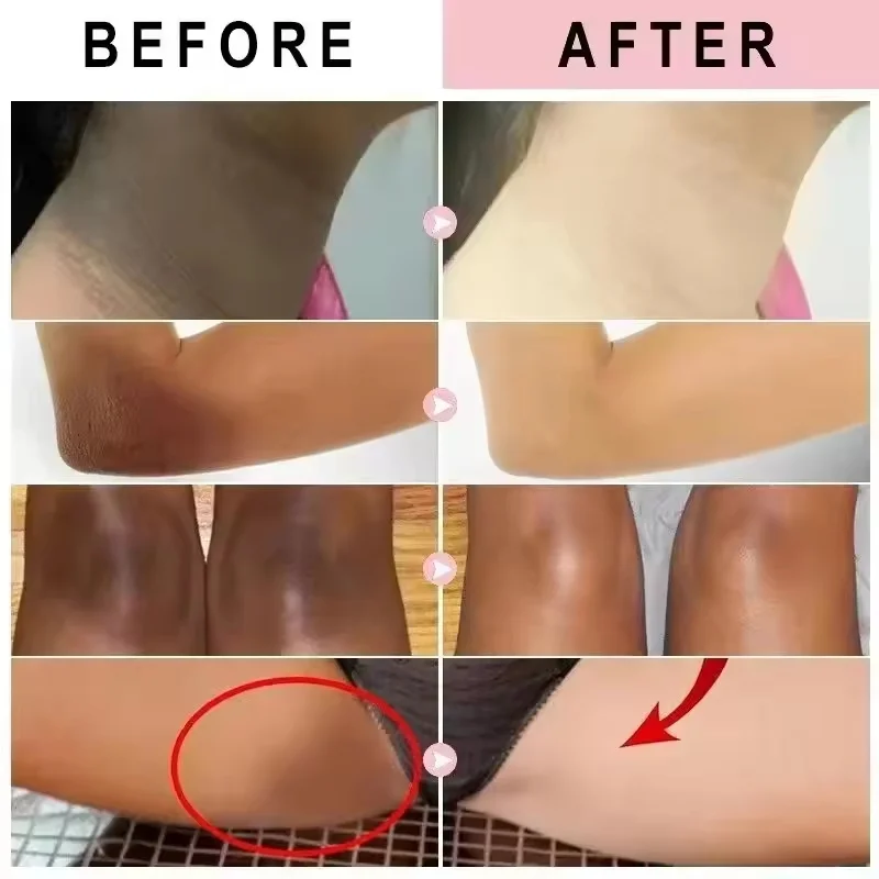 멜라닌 제거 니코틴아미드 브라이트닝 크림 다크 스킨 효과적인 허벅지 내부 표백제 개인 부품 브라이트닝 크림