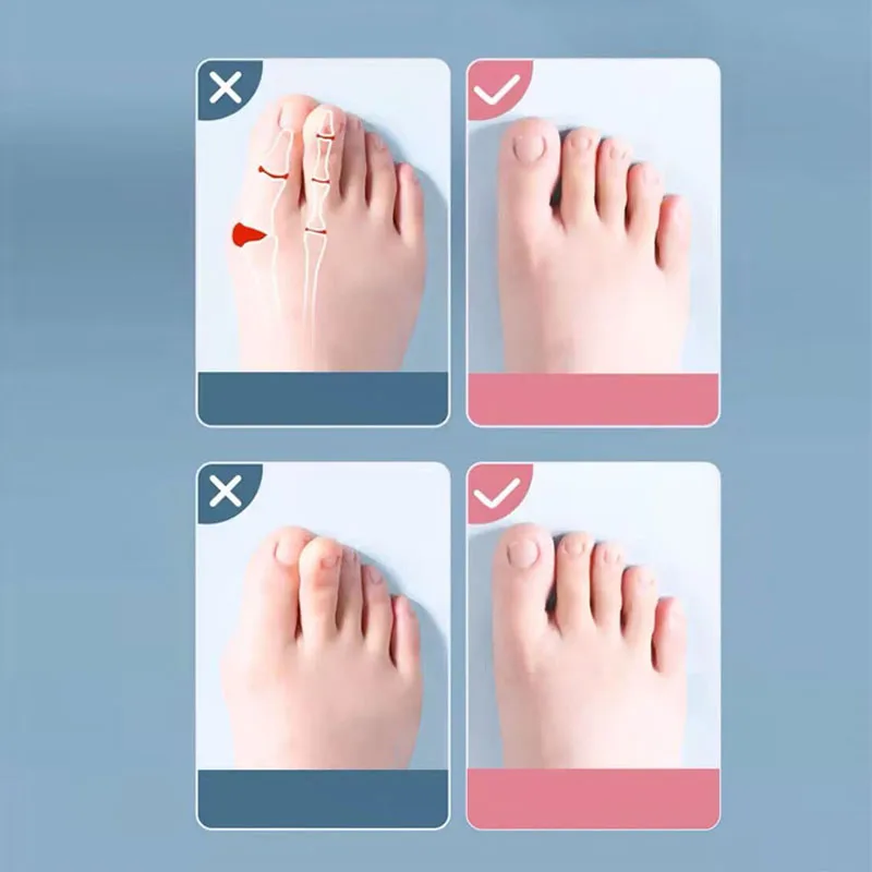 2Pc 실리콘 발가락 분리기 손가락 발 발가락 스프레더 Hallux Valgus Bunion 교정기 발가락 직선 기 교정기 손가락 구분 기호